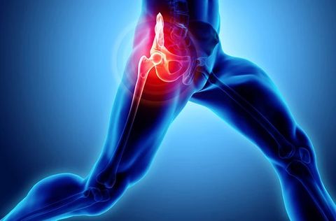 The Complete Guide to Alleviating Hip Pain: Effective Solutions and Treatments