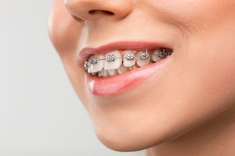 Understanding Teeth Braces: A Complete Guide to Options, Care, and Benefits