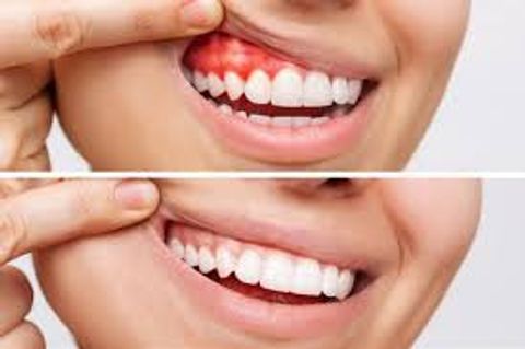 A Complete Guide to Understanding and Treating Bleeding Gums
