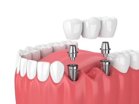 Dental Implants: The Complete Guide to a Confident Smile